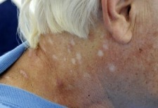 03/02/09 - Reno Man Claims Recovery From Mysterious Skin Disease